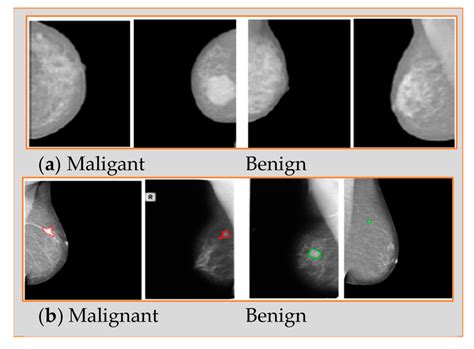 mammogram results for cancer patients